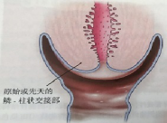 宮頸癌篩查沒(méi)那么簡(jiǎn)單，這些技巧助你提高取樣質(zhì)量